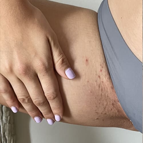 Ingrown Rescue Routine Before