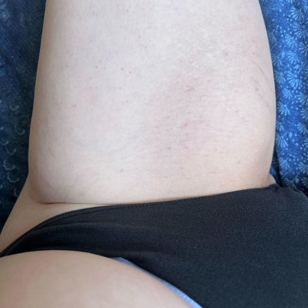 Scars Be Gone After