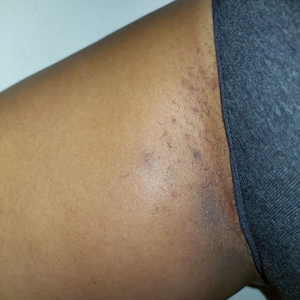 Ingrown Rescue Routine Before