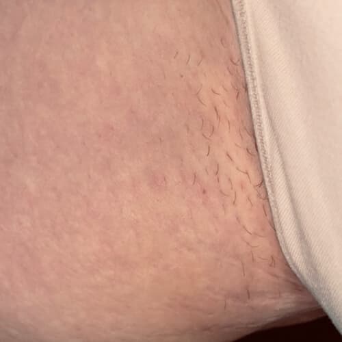 Scars Be Gone Before