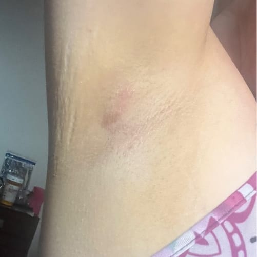 Dark Spots Out After