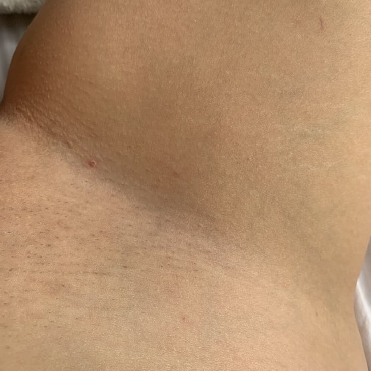 The Ultimate Hair Removal Routine After