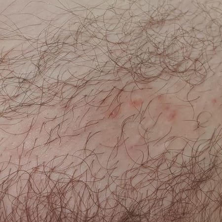 The Complete Intimate Skin Reset After