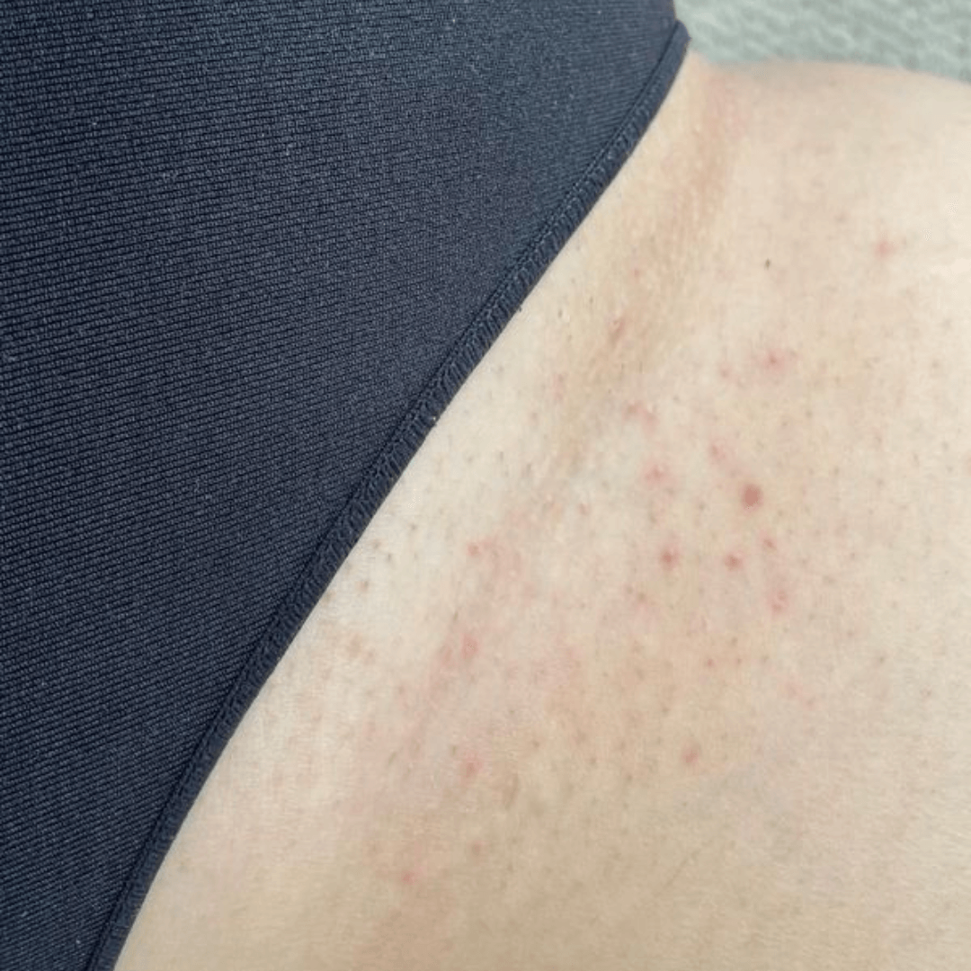 The Ultimate Hair Removal Routine After