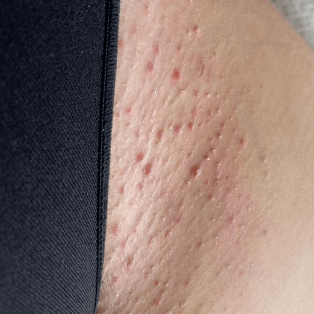 The Ultimate Hair Removal Routine Before