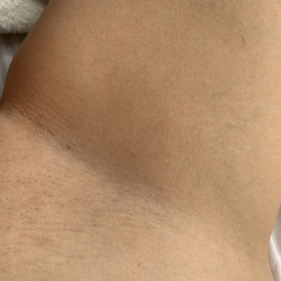 The Ultimate Hair Removal Routine After