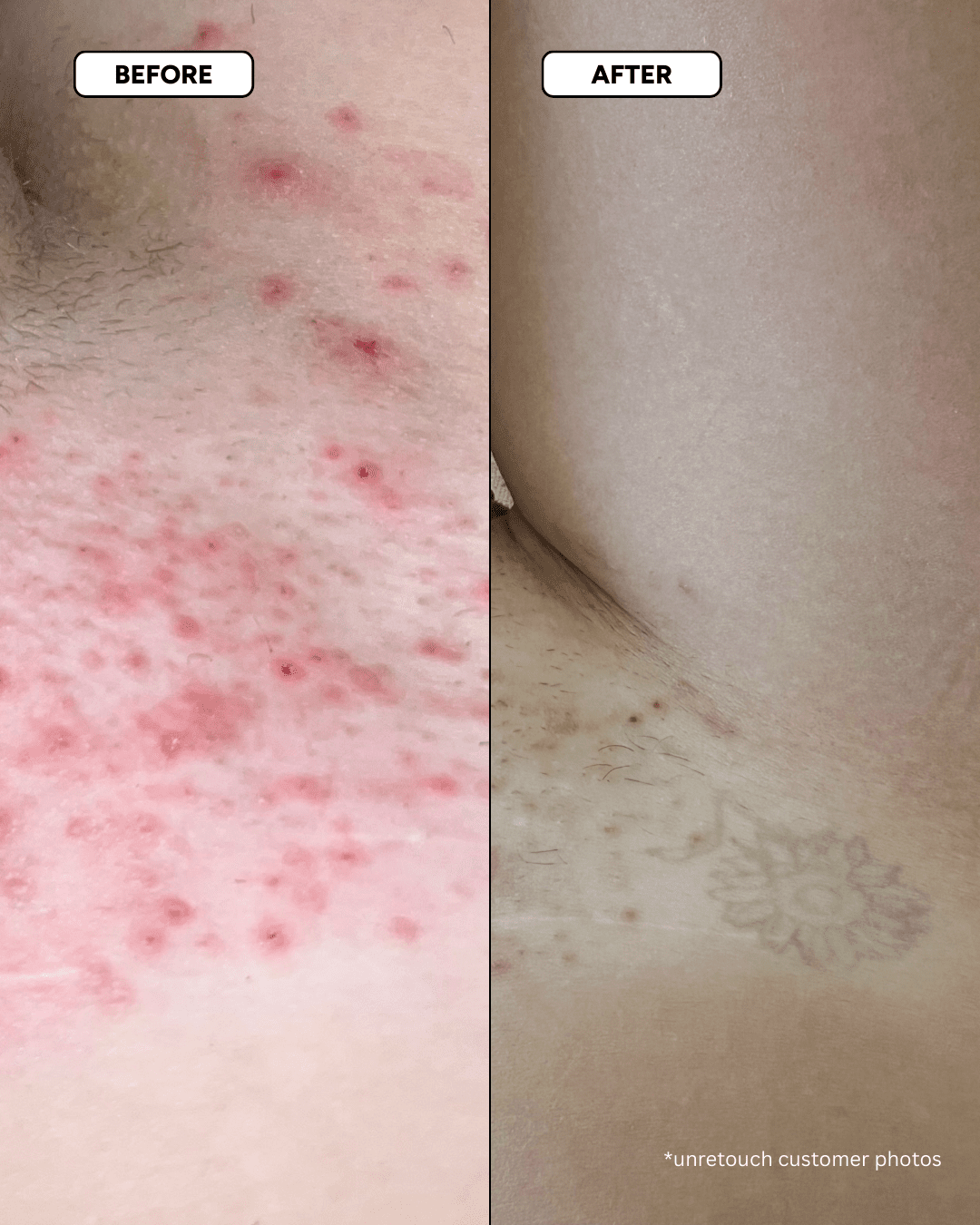 Ingrown Rescue Routine