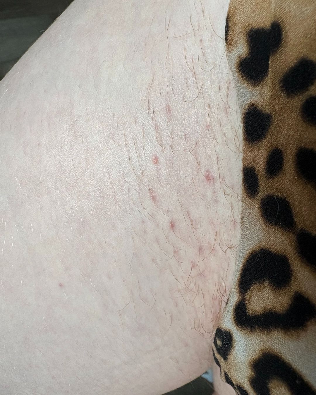 Fix My Ingrowns After