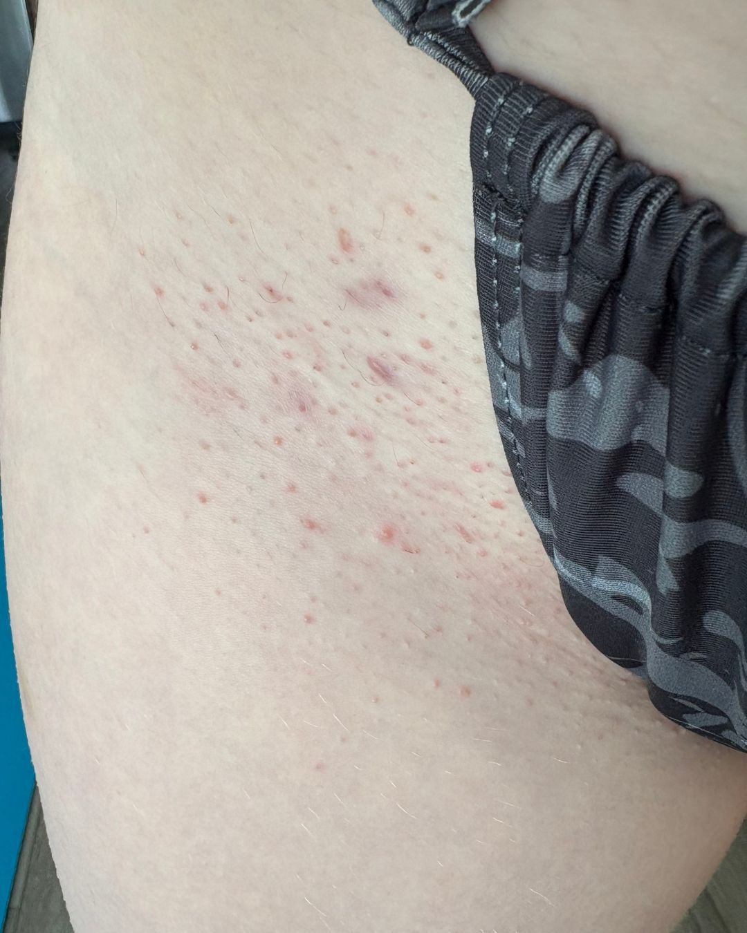 Fix My Ingrowns Before