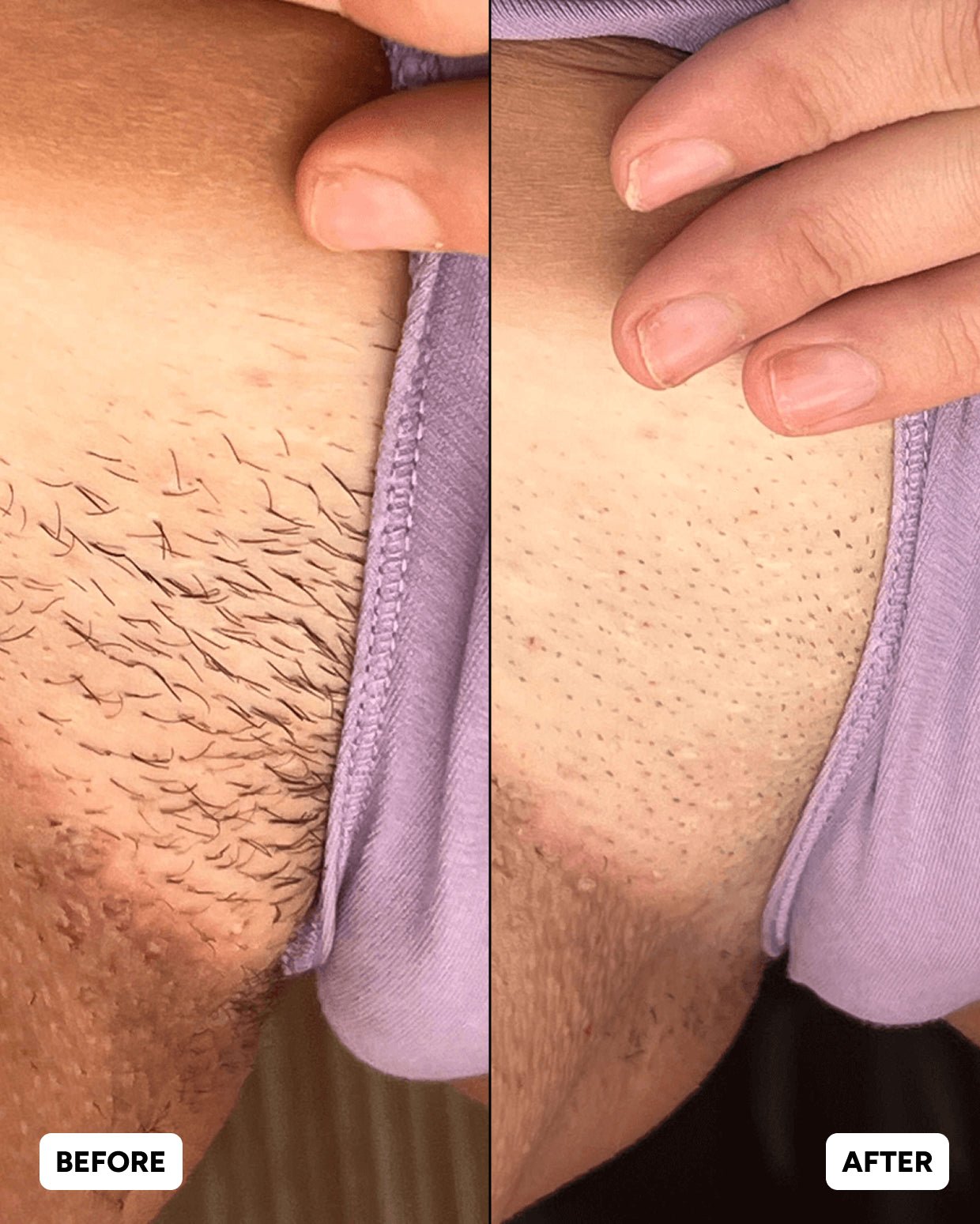 Hair Removal Routine