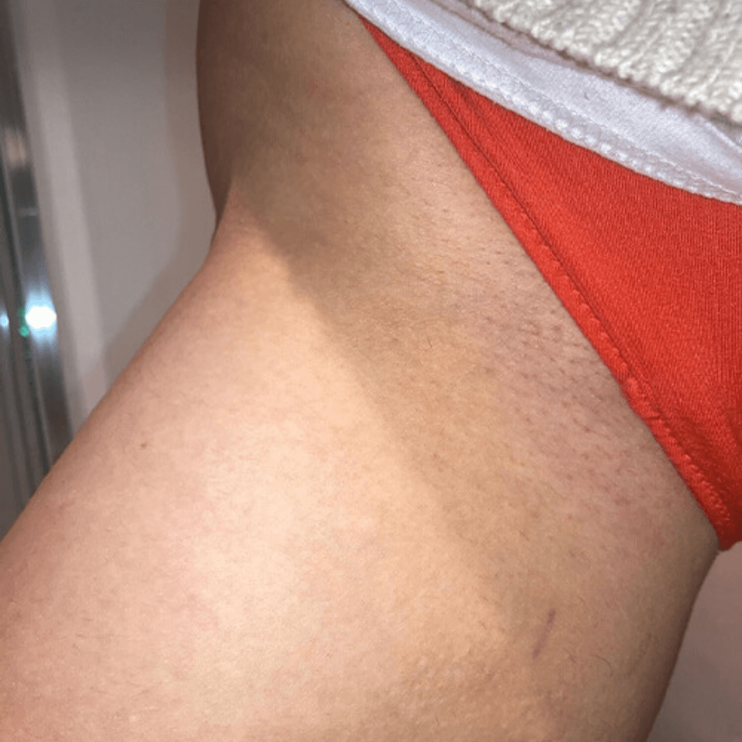 The Ultimate Hair Removal Routine After