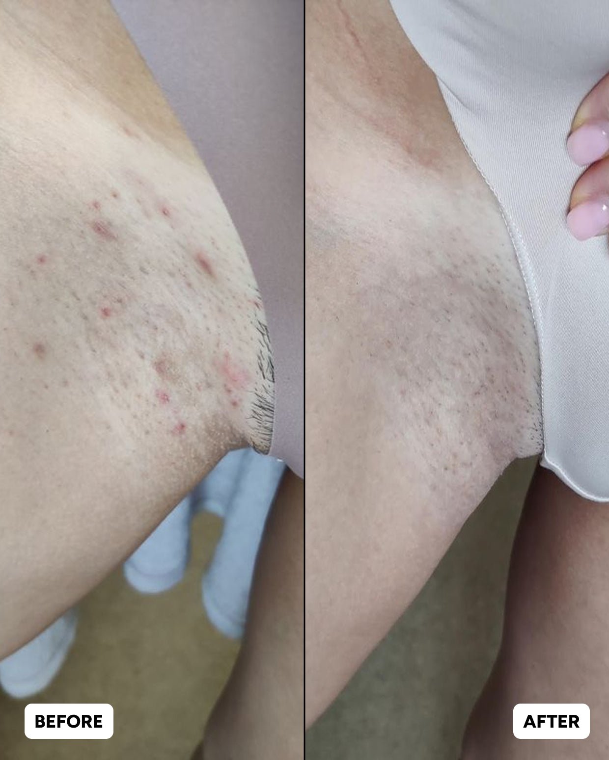 Ingrown Hairs Routine