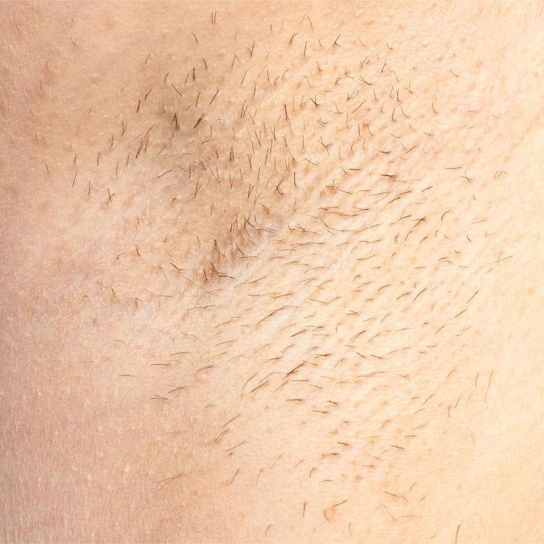 The Intimate IPL Routine After