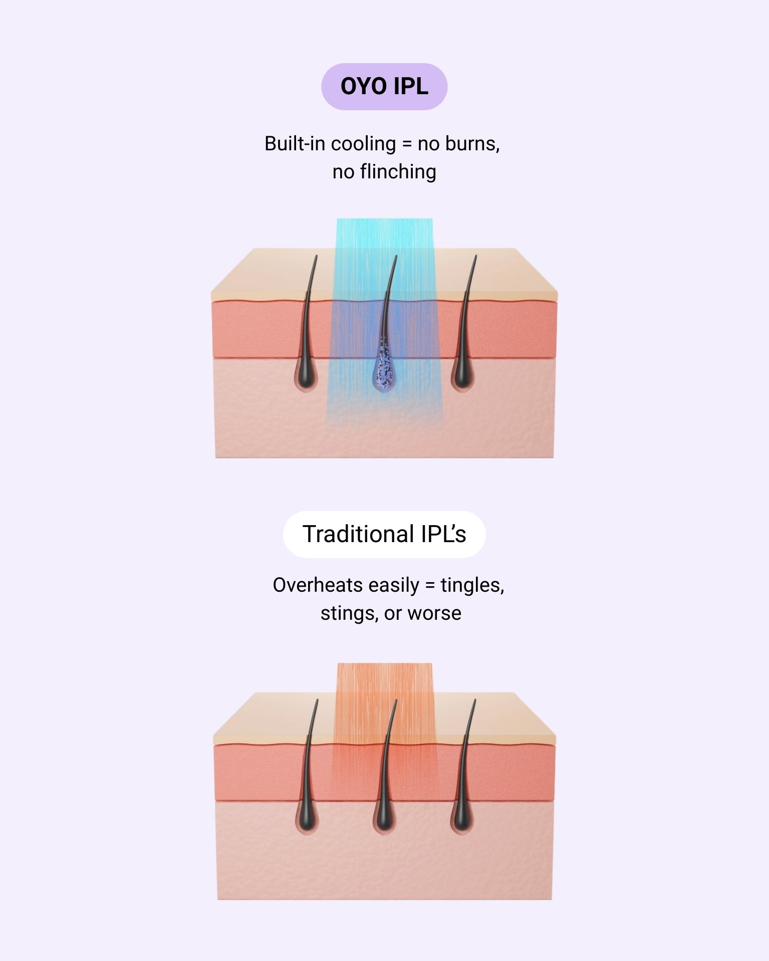 The intimate IPL routine